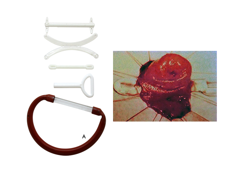 Support Rods for Loop Ostomy Construction