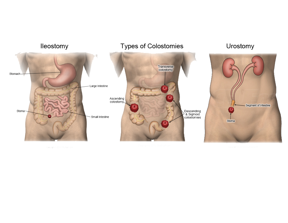 Types of Ostomies