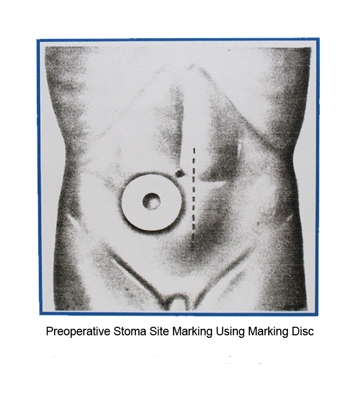 Preoperative Stoma Site Marking Using Marking Disc